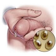 chlamydia discharge